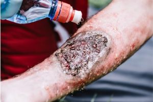Any burns covering more than 10% to 15% of the body surface or suspected third-degree burns should be assessed by a doctor. 