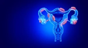 Vector of a cervix with endometrial growths (Image from Shutterstock)