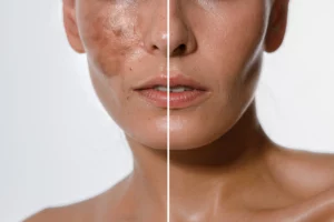 Hyperpigmentation of female skin, close-up of a part of the face on a white background, before and after acid peeling and cosmetic therapy, dermatology, skin care. 