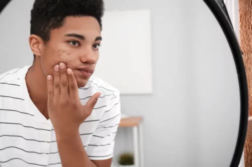African-American teenage boy with acne problem at home.