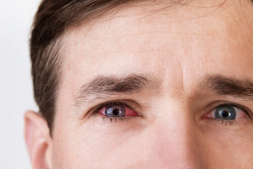 The man's face is close up on a light background, the man has red eyes because he has conjunctivitis, caught a cold and now drips special eye drops, medical concept.