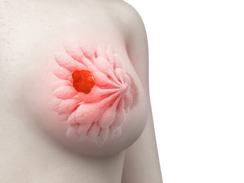 Vector of a female breast with a red cancer tumour