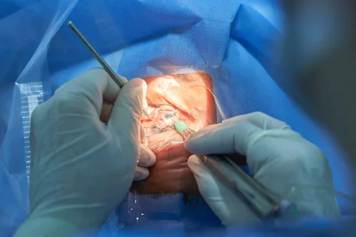 Photograph of a surgeon performing cataract surgery