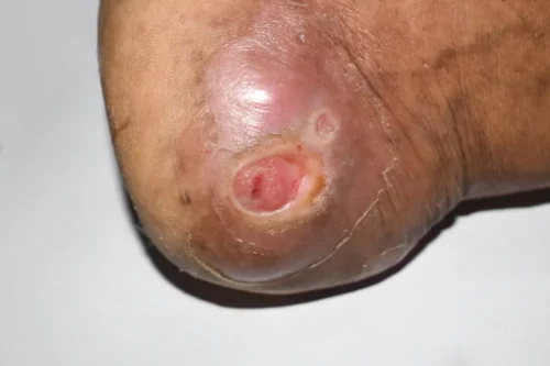 Diabetes foot ulcer in foot of Asian patient. Closeup view.