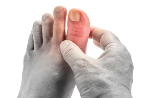 Toes of a man with gout on a white background
