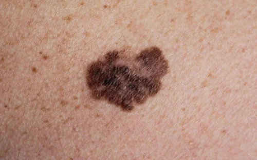 melanoma - a malignant tumour of the skin