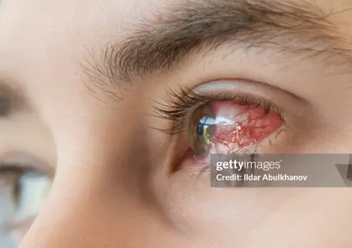 Bacterial conjunctivitis in a human eye