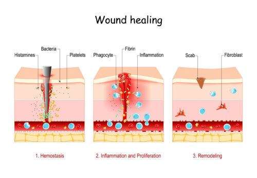 Wound,Healing.,Stages,Of,The,Post-trauma,Repairing,Process.,Hemostasis,,Inflammatory,