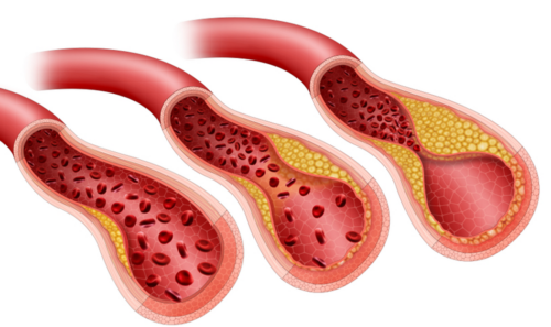 cholesterol veins